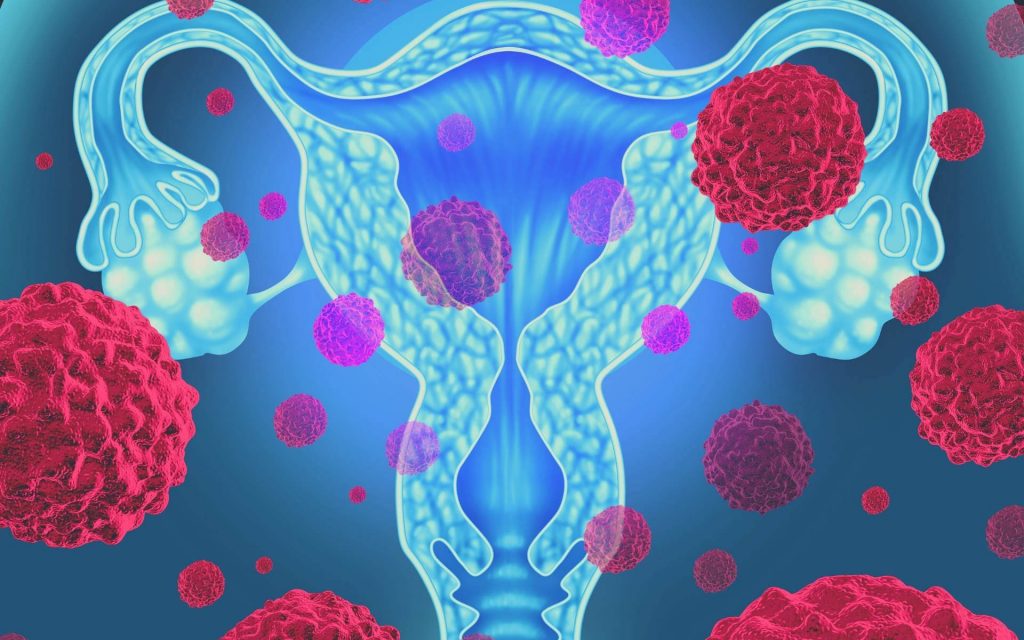 O que é o mioma uterino e quando devo me preocupar? • ISM