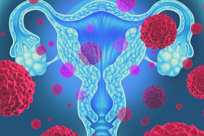 O que é o mioma uterino e quando devo me preocupar?